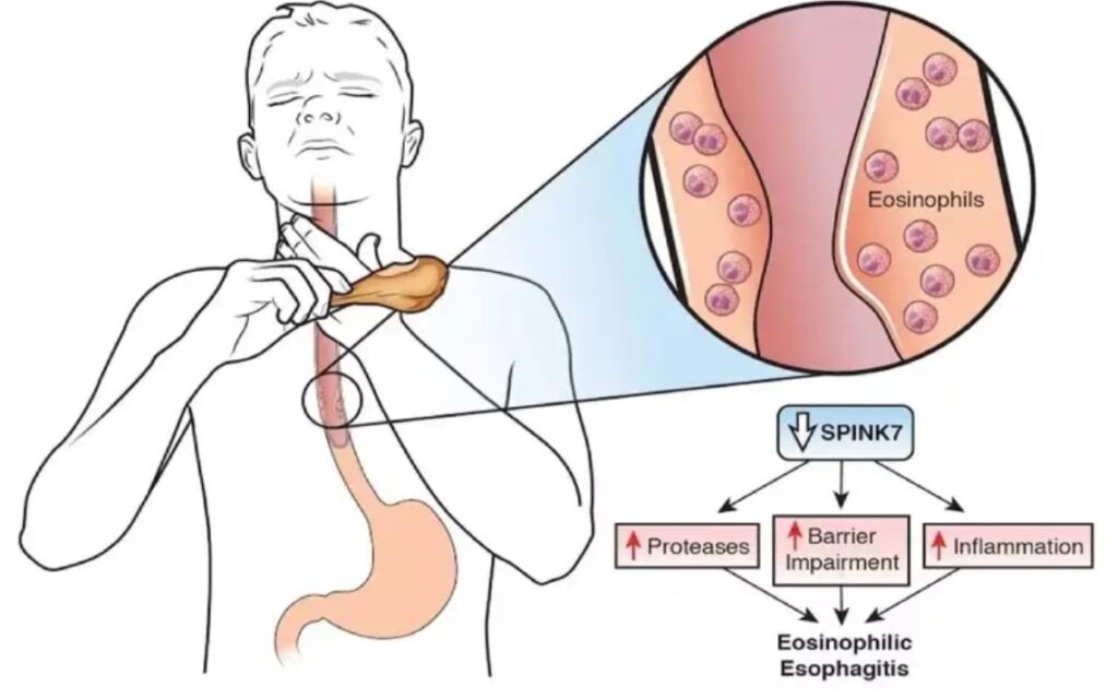Eosinophilic Esophagitis (EoE): The Hidden Cause of Heartburn